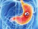 Be alert as soon as you see these signs, indicates stomach cancer