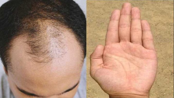 Men with such fingers are more at risk of becoming bald, are you also in danger?
