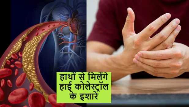 High Cholesterol: Symptoms of high cholesterol can also be seen in the hands, immediately identify such signs