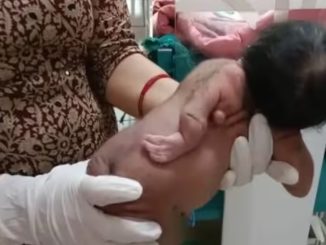 Rajasthan: Unique child with 3 hands born in Hanumangarh, third hand on back