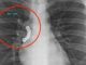 By mistake the person swallowed his false teeth, X-ray showed the report.. stuck in the throat