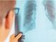 Multi drug resistance case of TB spreading like corona in Chhattisgarh, 600 people ill in Raipur