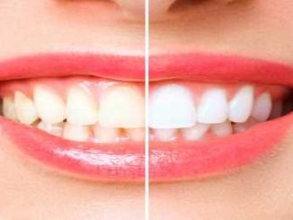 Yellowness of teeth not going away even after brushing twice a day? Adopt this home remedy, your teeth will shine like pearls