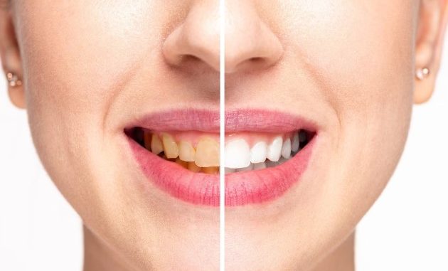Natural Teeth Whitening: These 5 home remedies will remove yellowness from teeth, your teeth will start shining like pearls.