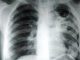 40 percent Indians have symptoms of TB, delay in detection is fatal: Expert