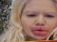 Girl got her lips thickened to give herself a gift on Christmas, made this world record
