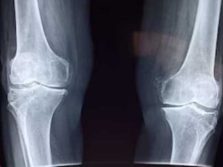 These 5 foods make the bones hollow from inside, the risk of fracture increases