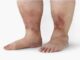 Be careful if you see 5 symptoms in your feet! Could be a sign of diabetes