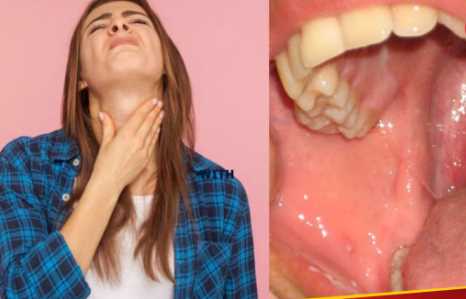 Try to stop the growth of tonsils in the throat before it starts, identify the initial symptoms of the disease in this way