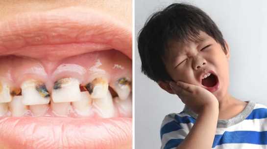 Due to these 5 reasons, children's teeth get infected by worms, keep these things in mind for protection