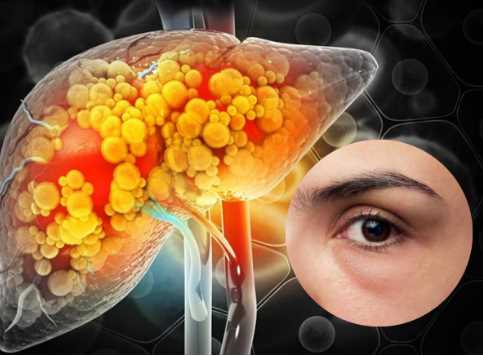 Fatty Liver: If swelling starts in these organs then understand that fatty liver is taking a terrible form, it is better to keep following these measures.