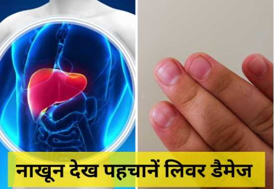 Liver Damage Sign: Liver damage can be detected by looking at the nails, these are the changes in color and shape.