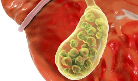 What causes stones to form in the gall bladder? Know the symptoms of gallstones