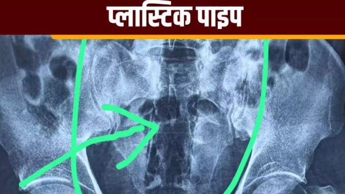 सेक्स की सनकः खुद के प्राइवेट पार्ट में ठूंस लिया प्लास्टिक पाइप, फिर…